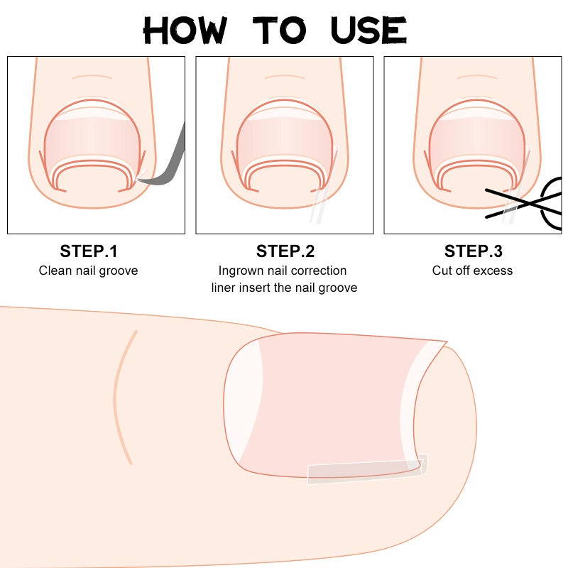 مايتيز 60 قطعة من شرائط تصحيح الأظافر الغائرة، دعامة لتصحيح الأظافر الغائرة، مشبك لتقويم الأظافر، رقعة لتصحيح الأظافر المنحنية، مناسبة للنساء والرجال، للعناية بالقدم، بنمطين - Image 3